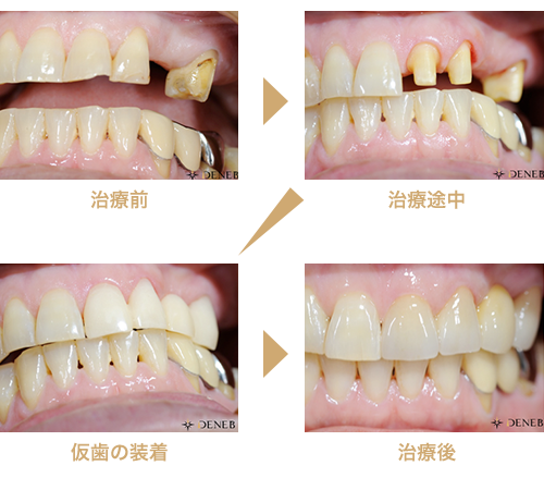 ケース1 左上3番のブリッジ審美治療 治療症例集 デネブデンタルクリニック 三鷹市井口の歯医者 スターバックスの２階 インプラント セラミック