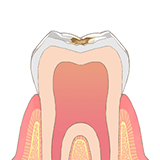 小さい虫歯　イメージ図