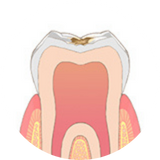 小さい虫歯　イメージ図