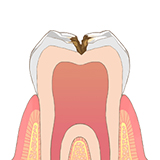 大きい虫歯の場合　イメージ図