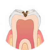 大きい虫歯の場合　イメージ図