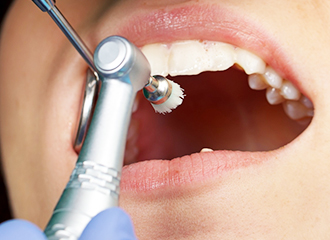予防歯科でプロ仕様のクリーニング　イメージ写真