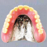 金属の総義歯　写真