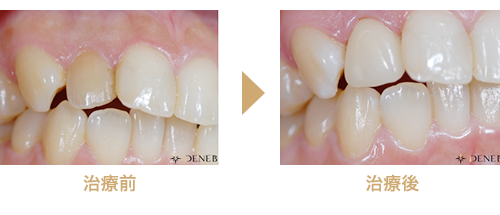 ケース3 右上2番の審美セレック治療 治療症例集 デネブデンタルクリニック 三鷹市井口の歯医者 スターバックスの２階 インプラント セラミック