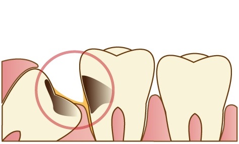 口腔外科 親知らず 三鷹のデネブデンタルクリニック